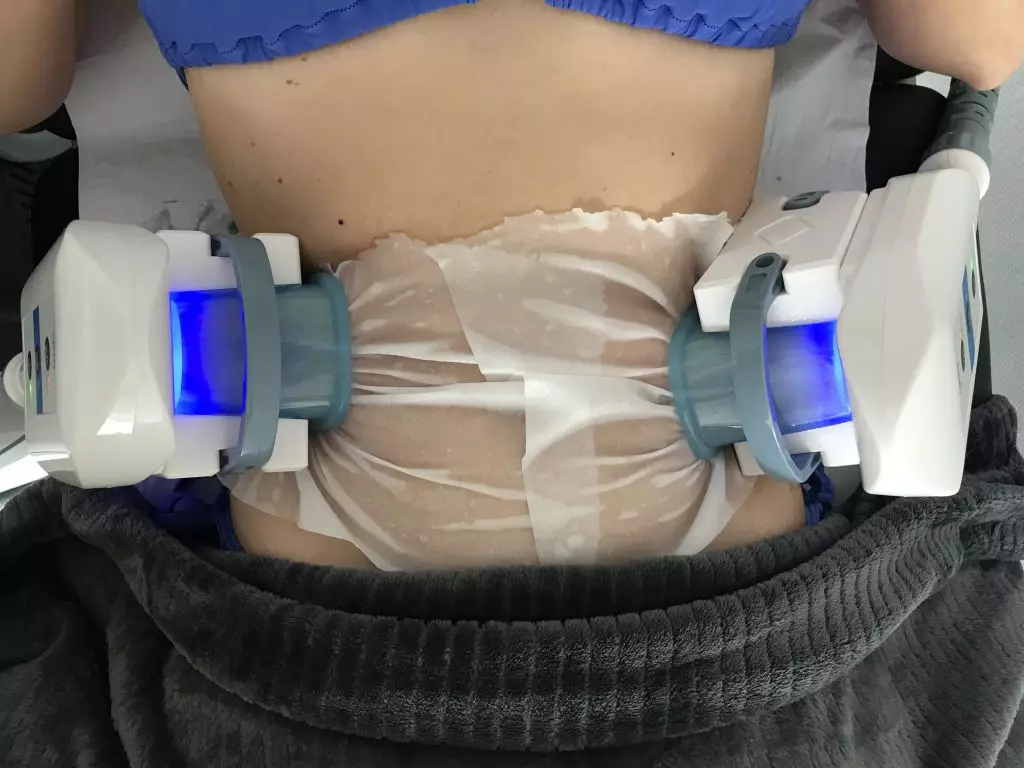 Cryolipolyse autour de Labège